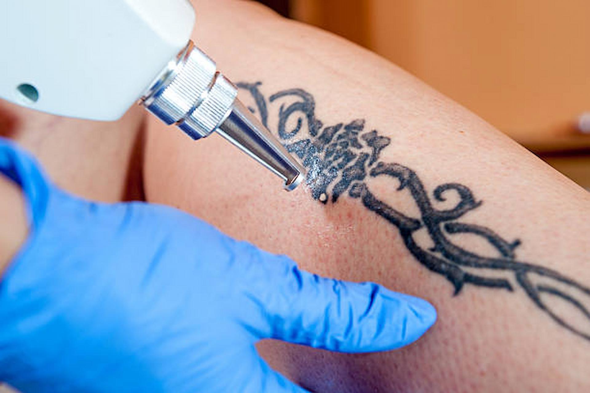 Factors To Consider When Opting For Tattoo Removals In London